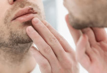 თურმე ჰერპესის მოშორება 1 დღეშია შესაძლებელი – ეს ხერხი ახლავე უნდა ისწავლოთ