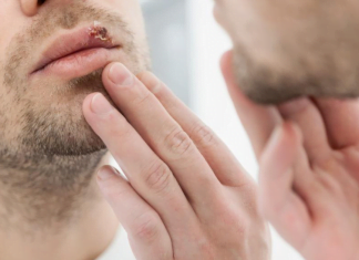 თურმე ჰერპესის მოშორება 1 დღეშია შესაძლებელი – ეს ხერხი ახლავე უნდა ისწავლოთ