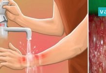 პირველი დახმარება დამწვრობის დროს – ინფორმაცია, რომელიც ყველა მშობელმა უნდა იცოდეს!