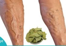 დაფნის ფოთლებით ვენების ვარიკოზისა და სახსრების ტკივილისგან განიკურნებით