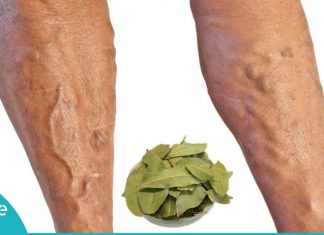 დაფნის ფოთლებით ვენების ვარიკოზისა და სახსრების ტკივილისგან განიკურნებით
