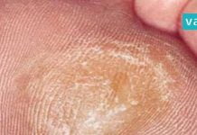 როგორ მოვიშოროთ კოჟრები სწრაფად და მარტივად? ხერხები, რომლებიც ბევრს გამოადგება