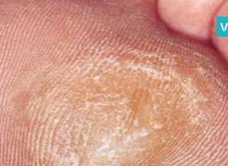 როგორ მოვიშოროთ კოჟრები სწრაფად და მარტივად? ხერხები, რომლებიც ბევრს გამოადგება