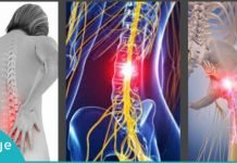 რადიკულიტის მკურნალობის 8 ეფექტური მეთოდი – საცდეთ გამაყუჩებლების ნაცვლად!