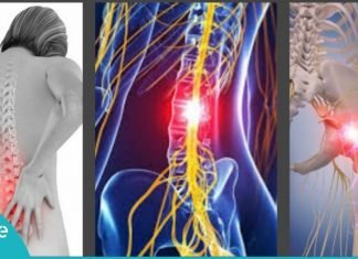 რადიკულიტის მკურნალობის 8 ეფექტური მეთოდი – საცდეთ გამაყუჩებლების ნაცვლად!