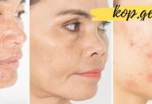 დაემშვიდობეთ ნაოჭებს, აკნეს და მუქ ლაქებს ოხრახუშის მეშვეობით