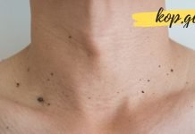 ამ ერთი ნატურალური ინგრედიენტის გამოყენებით, მეჭეჭებისგან სამუდამოდ გათავისუფლდებით !