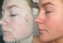 დერმატოლოგები გაგიჟებულები არიან: ამ მეთოდით მუქ წერტილებს და აკნეს 3 დღეში გაიქრობთ!