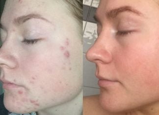 დერმატოლოგები გაგიჟებულები არიან: ამ მეთოდით მუქ წერტილებს და აკნეს 3 დღეში გაიქრობთ!