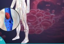 თრომბის განვითარების 10 სიმპტომი, რომლებიც უნდა იცოდეთ. მოუსმინეთ თქვენს ორგანიზმს!