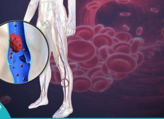 თრომბის განვითარების 10 სიმპტომი, რომლებიც უნდა იცოდეთ. მოუსმინეთ თქვენს ორგანიზმს!