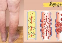 ბუნებრივი საშინაო საშუალებები, რომლებიც სისხლს ათხელებს, ეს ნამდვილად მნიშვნელოვანია