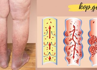 ბუნებრივი საშინაო საშუალებები, რომლებიც სისხლს ათხელებს, ეს ნამდვილად მნიშვნელოვანია