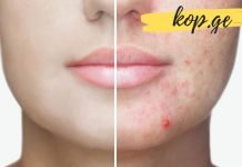 გაწუხებთ აკნე? მაშინ ეს სამი საშუალება აუცილებლად დაგეხმარებათ