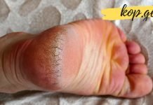 ქუსლები აღარ აგექერცლებათ – ეს მარტივი საშუალება სამოდამოდ აქრობს ქუსლის დახეთქვის რისკს