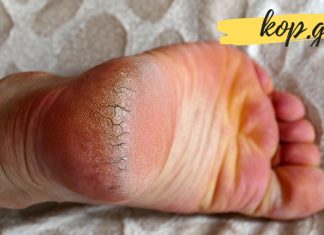 ქუსლები აღარ აგექერცლებათ – ეს მარტივი საშუალება სამოდამოდ აქრობს ქუსლის დახეთქვის რისკს