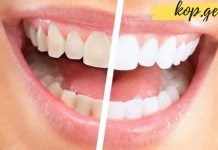 როგორ გავითეთროთ კბილები 3 წუთში. მეთოდი, რომელსაც დღესაც წარმატებით იყენებენ