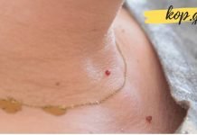 რას გვეუბნება სხეულზე წითელი წერტილები? ეს უნდა იცოდეთ