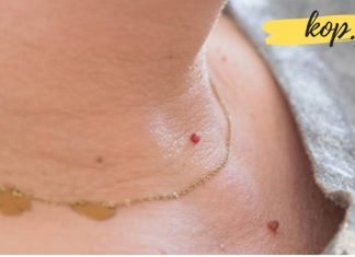 რას გვეუბნება სხეულზე წითელი წერტილები? ეს უნდა იცოდეთ