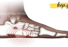 შეიძლება თუ არა ბრტყელტერფიანობამ სერიოზული დაავადებები გამოიწვიოს?! ამას არ მოველოდი