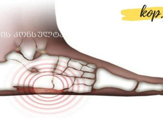 შეიძლება თუ არა ბრტყელტერფიანობამ სერიოზული დაავადებები გამოიწვიოს?! ამას არ მოველოდი