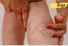 როგორ გავაქროთ კანზე შესამჩნევი ვენები? მარტივი და ეფექტური გამოსავალი