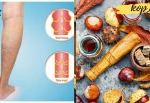 როგორ ავიცილოთ თრომბოფლებიტი და ვარიკოზული ვენები!