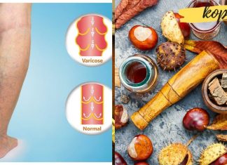 როგორ ავიცილოთ თრომბოფლებიტი და ვარიკოზული ვენები!
