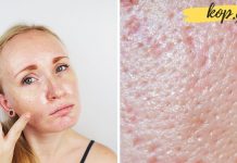 როგორ მოვუაროთ ცხიმიან კანს? ეს ძალიან ეფექტური ხერხია