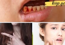 თუ თქვენს სახეზე ეს ნიშნები შენიშნეთ ე.ი. ორგანიზმი ვიტამინების ნაკლებობას განიცდის. ეს უნდა იცოდეთ