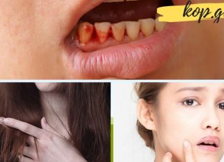 თუ თქვენს სახეზე ეს ნიშნები შენიშნეთ ე.ი. ორგანიზმი ვიტამინების ნაკლებობას განიცდის. ეს უნდა იცოდეთ