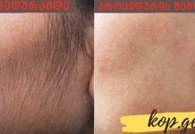 სახიდან არასასურველი თმის სამუდამოდ მოშორების უძველესი მეთოდი შვრიით, თაფლითა და ლიმონით