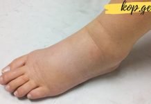 ეს ყველაზე ძლიერი ბუნებრივი საშუალებაა ფეხების შეშუპების წინააღმდეგ!