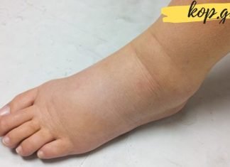 ეს ყველაზე ძლიერი ბუნებრივი საშუალებაა ფეხების შეშუპების წინააღმდეგ!