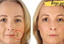 როგორ გავუმკლავდეთ ნაზოლაბიალური ნაოჭებს ბუნებრივი მეთოდებით?