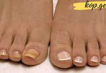 როგორ ვუმკურნალოთ გაყვითლებულ ფეხის ფრჩხილებს? ეს საშუალებები დაგეხმარებათ