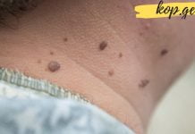 ამის დახმარებით თუ შევძლებდი პაპილომების მოშორებას სახიდან ნამდვილად არ მეგონა