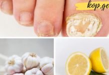 როგორ ვებრძოლოთ ფრჩხილის სოკოს? 6 ეფექტური პროდუქტი, რომელიც ამ დაავადებას დაგავიწყებთ