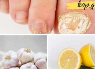 როგორ ვებრძოლოთ ფრჩხილის სოკოს? 6 ეფექტური პროდუქტი, რომელიც ამ დაავადებას დაგავიწყებთ