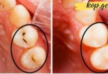 როგორ ვუმკურნალოთ გამოხრულ კბილებს სახლის პირობებში? იდეალური გამოსავალია
