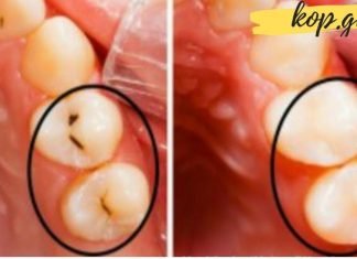 როგორ ვუმკურნალოთ გამოხრულ კბილებს სახლის პირობებში? იდეალური გამოსავალია