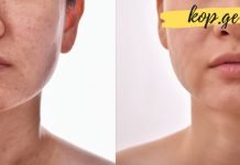 ეს საშუალებები ყველაზე ეფექტურია რაც კი აქამდე მიცდია ნაწიბურების მოსაშორებლად