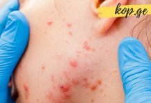 რა იწვევს აკნეს და როგორ ავიცილოთ თავიდან?
