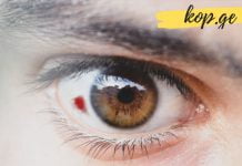 წითელი ლაქა თვალის არეში: რა უნდა გააკეთოთ თუ ის შეამჩნიეთ?