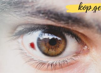 წითელი ლაქა თვალის არეში: რა უნდა გააკეთოთ თუ ის შეამჩნიეთ?