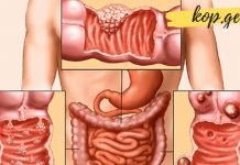 როგორ ვუმკურნალოთ კოლიტს? ეს ყველაზე ეფექტური მეთოდებია