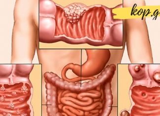 როგორ ვუმკურნალოთ კოლიტს? ეს ყველაზე ეფექტური მეთოდებია