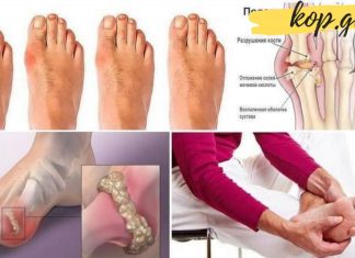 რა უნდა გავაკეთოთ იმისთვის, რომ სახლის პირობებში მოვიშოროთ ზედმეტი მარილები სხეულიდან?