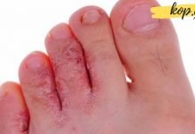 ფეხის კანის სოკოვანი დაზიანება: დამახასიათებელი ნიშნები და მკურნალობის მეთოდები