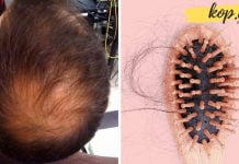 8 ბუნებრივი საშუალება თმის ცვენის შესაჩერებლად